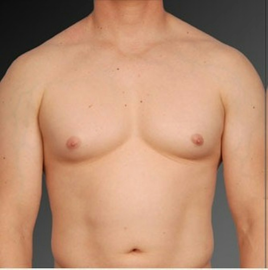 Patient 106041447 | Front View | Before | Chest (Gynecomastia) — Steven Teitelbaum MD -