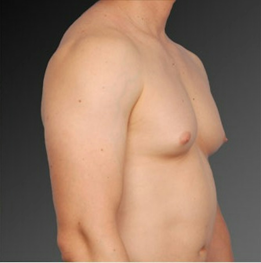 Patient 106041447 | Angle View | Before | Chest (Gynecomastia) — Steven Teitelbaum MD -