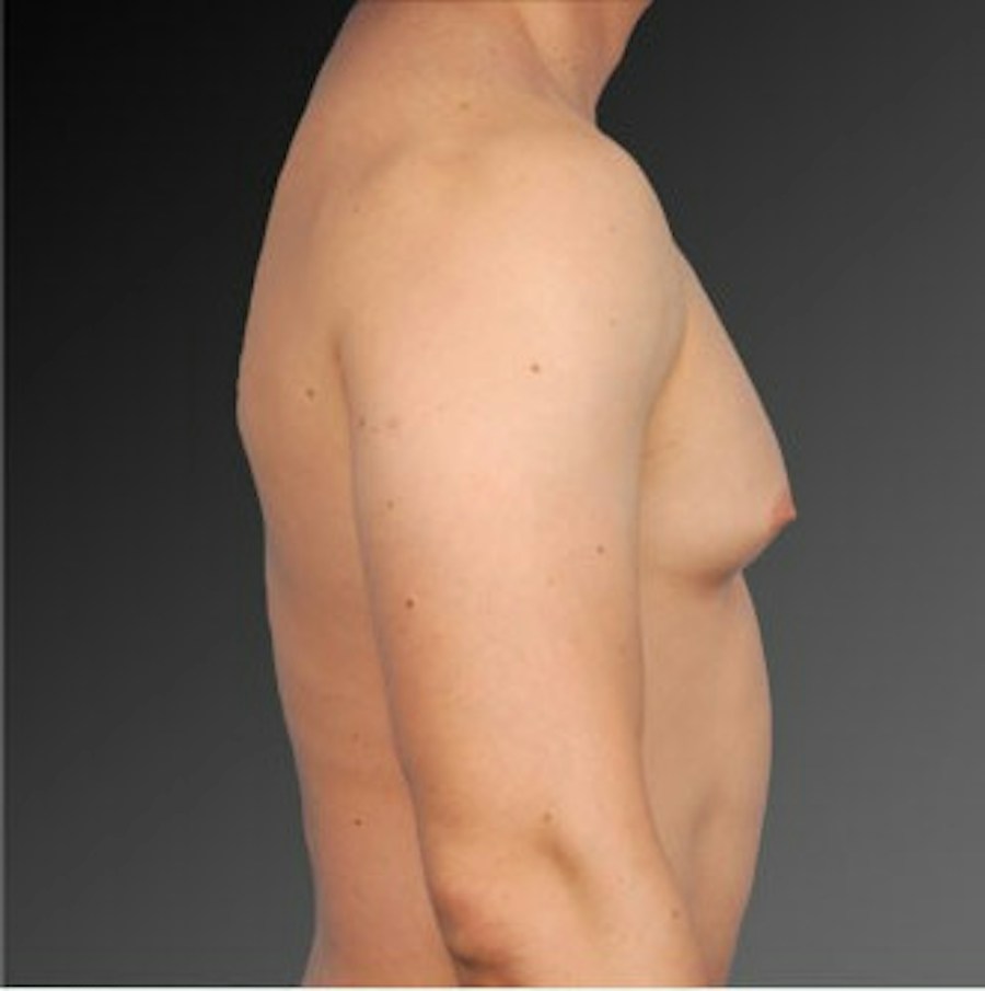 Patient 106041447 | Profile View | Before | Chest (Gynecomastia) — Steven Teitelbaum MD -