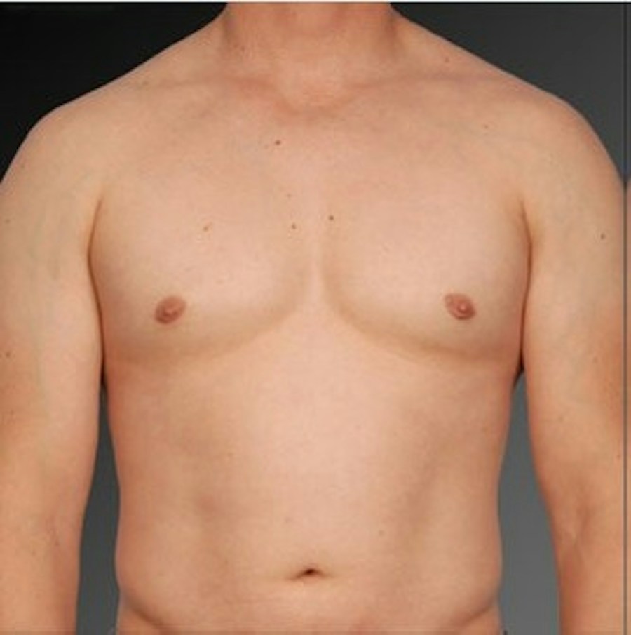 Patient 106041447 | Front View | After | Chest (Gynecomastia) — Steven Teitelbaum MD - Santa Monica