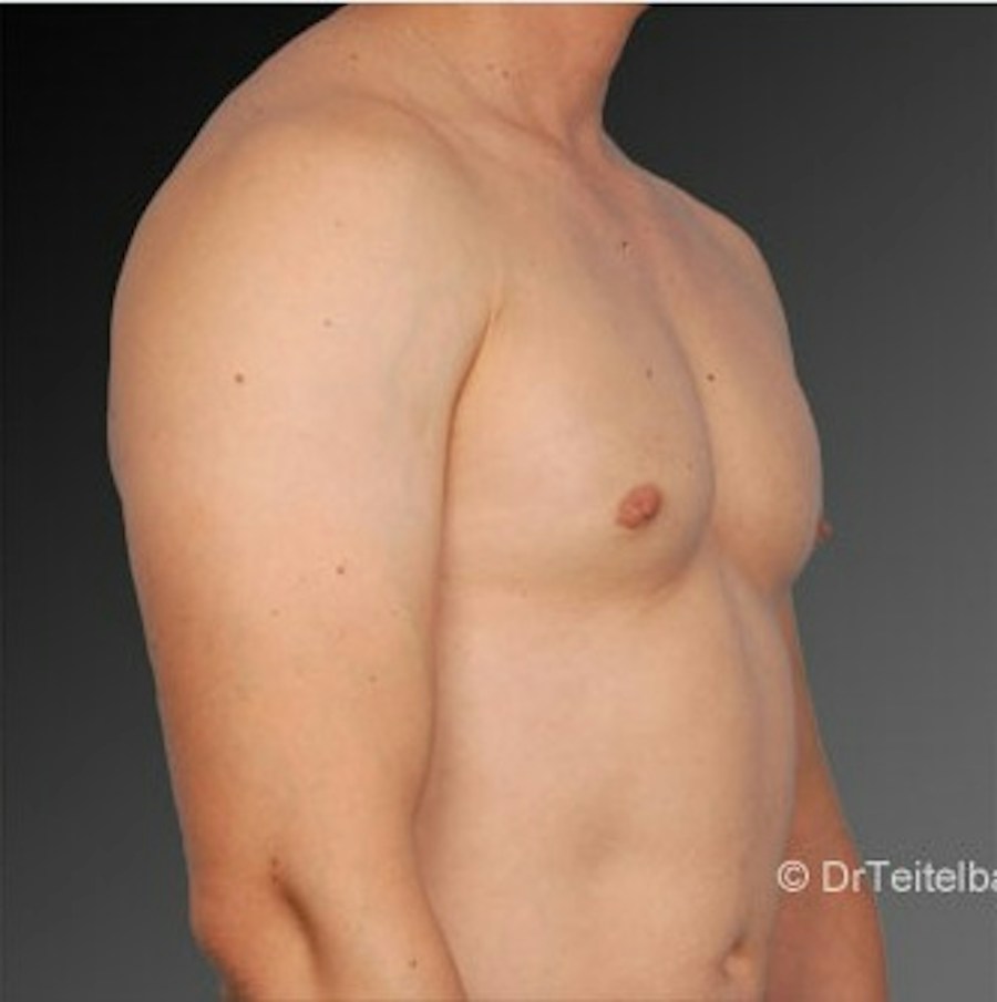 Patient 106041447 | Angle View | After | Chest (Gynecomastia) — Steven Teitelbaum MD -