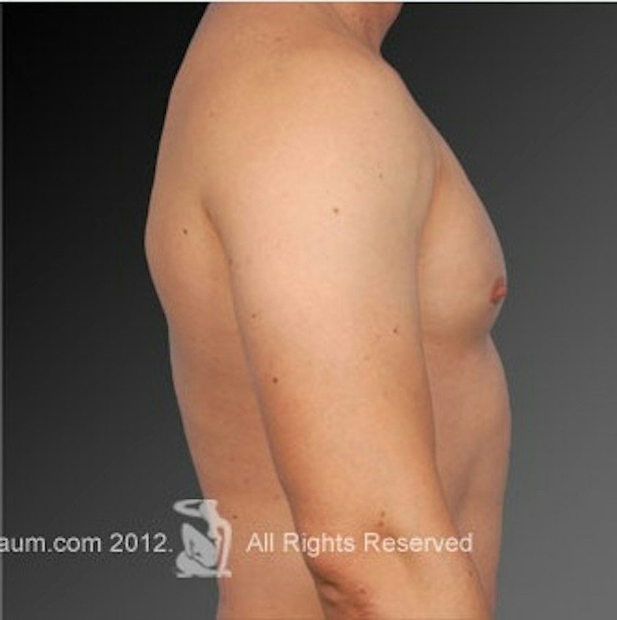 Patient 106041447 | Profile View | After | Chest (Gynecomastia) — Steven Teitelbaum MD -