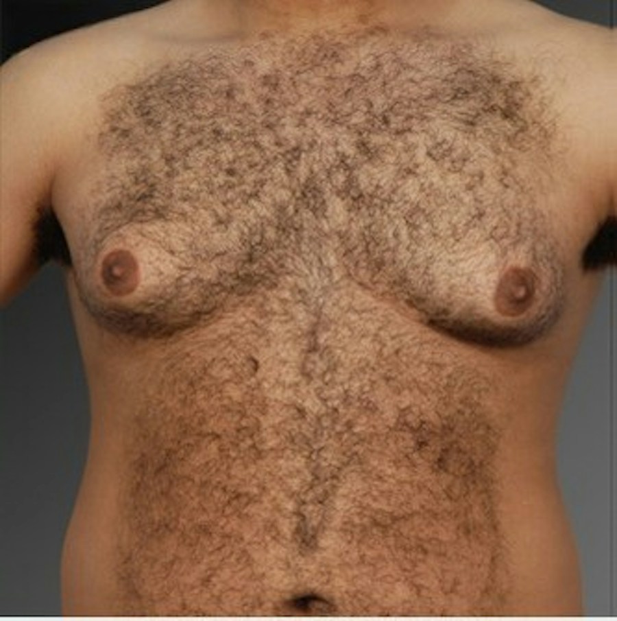 Patient 106041448 | Front View | Before | Chest (Gynecomastia) — Steven Teitelbaum MD -