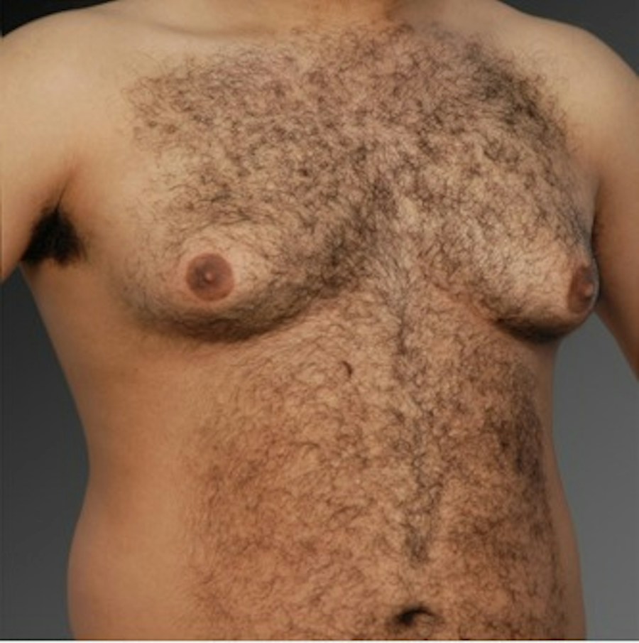 Patient 106041448 | Angle View | Before | Chest (Gynecomastia) — Steven Teitelbaum MD -