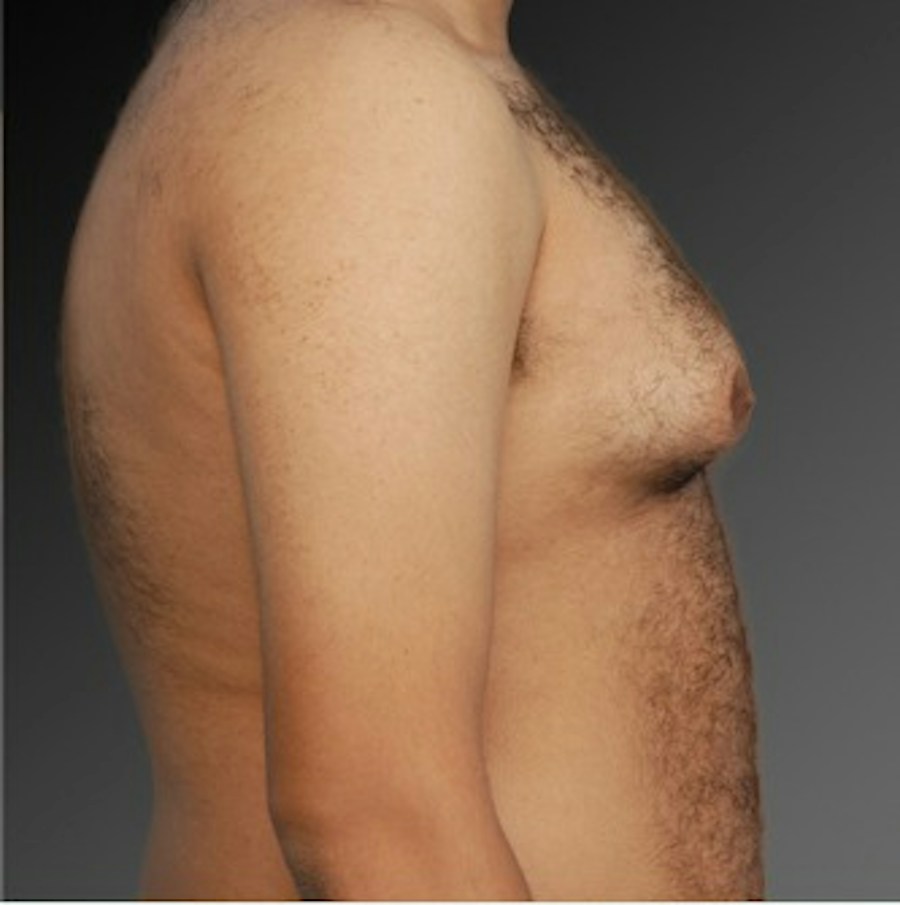 Patient 106041448 | Profile View | Before | Chest (Gynecomastia) — Steven Teitelbaum MD -