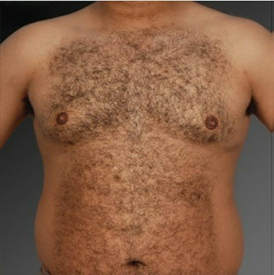 Patient 106041448 | Front View | After | Chest (Gynecomastia) — Steven Teitelbaum MD -