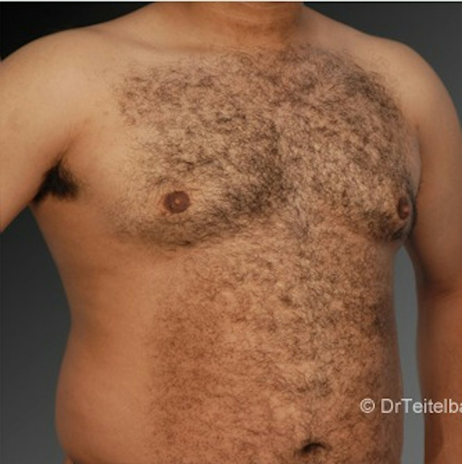 Patient 106041448 | Angle View | After | Chest (Gynecomastia) — Steven Teitelbaum MD -