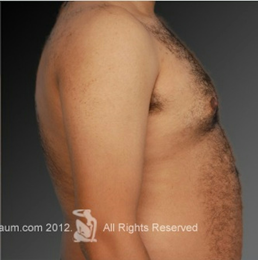 Patient 106041448 | Profile View | After | Chest (Gynecomastia) — Steven Teitelbaum MD -