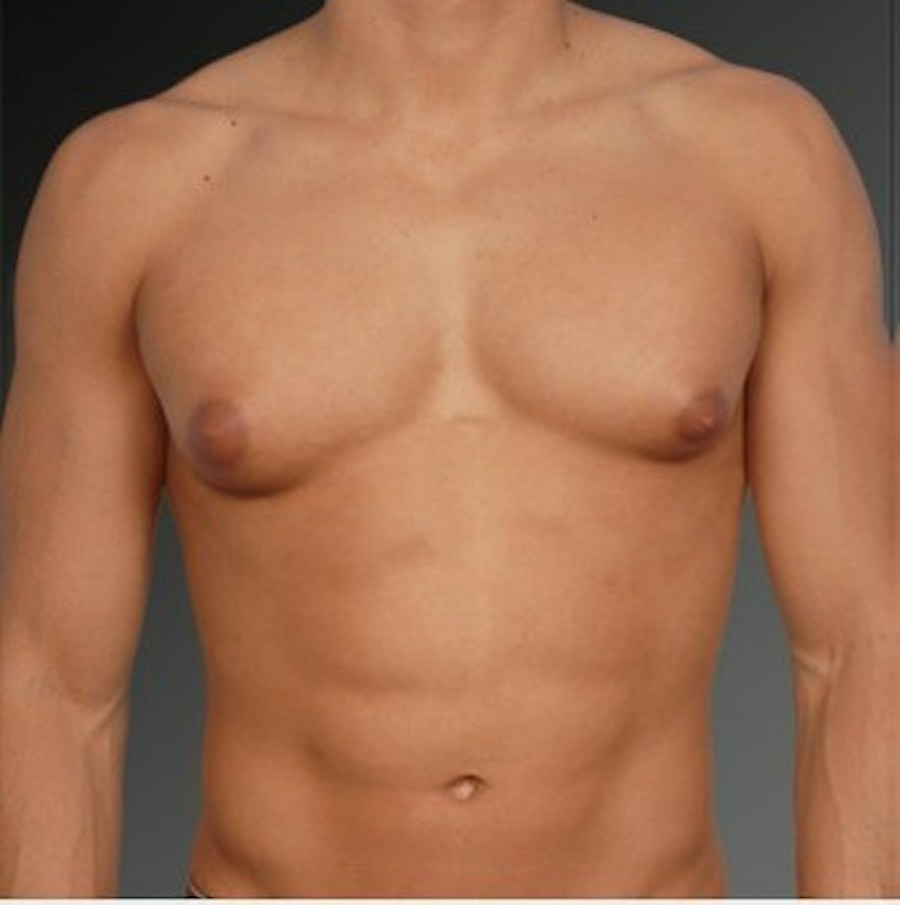 Patient 106041449 | Front View | Before | Chest (Gynecomastia) — Steven Teitelbaum MD -