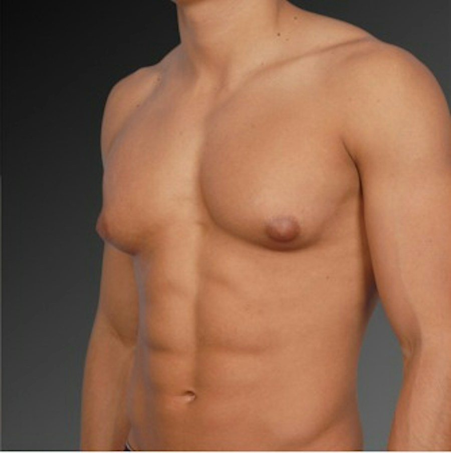 Patient 106041449 | Angle View | Before | Chest (Gynecomastia) — Steven Teitelbaum MD -