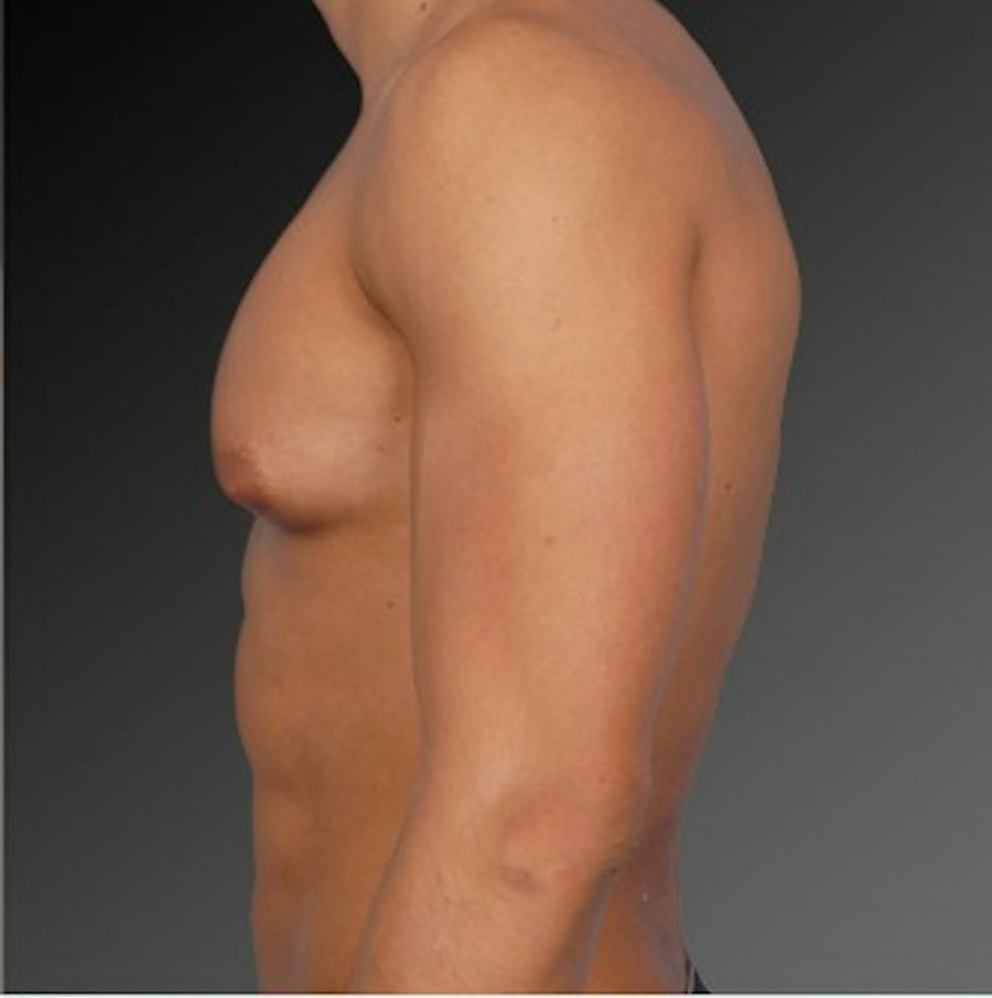 Patient 106041449 | Profile View | Before | Chest (Gynecomastia) — Steven Teitelbaum MD -