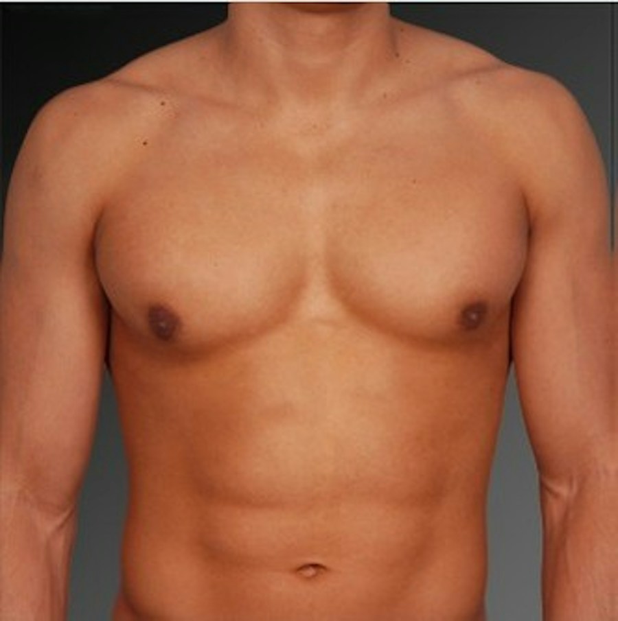 Patient 106041449 | Front View | After | Chest (Gynecomastia) — Steven Teitelbaum MD -