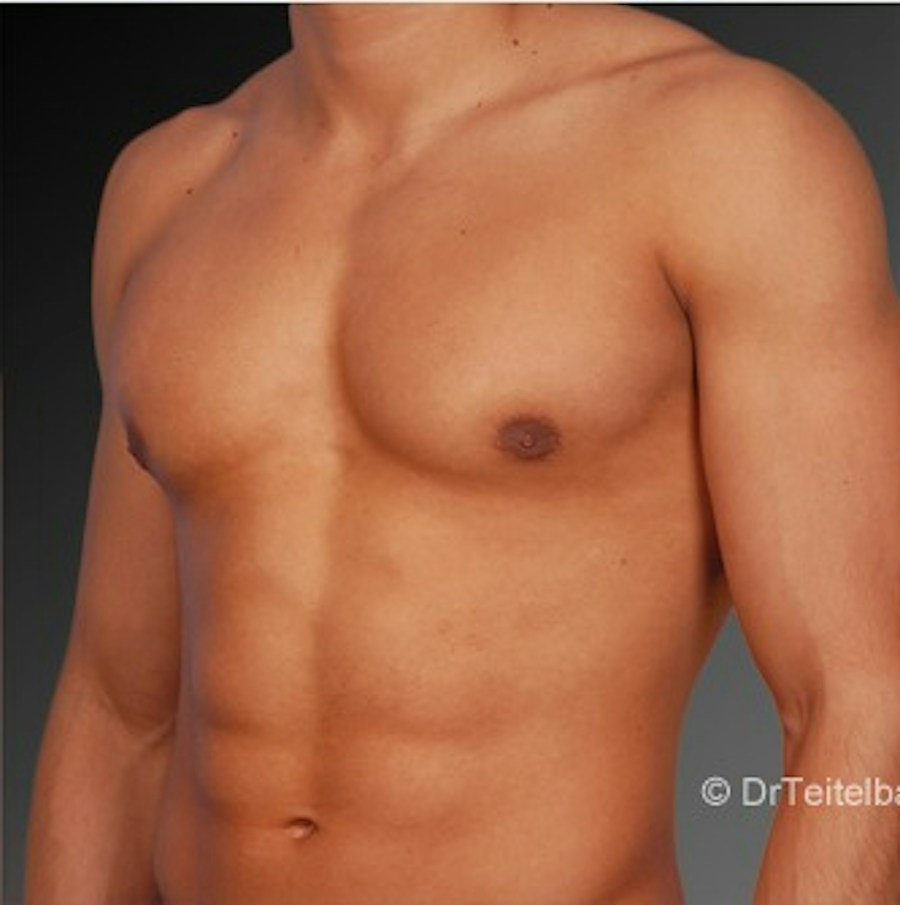 Patient 106041449 | Angle View | After | Chest (Gynecomastia) — Steven Teitelbaum MD -