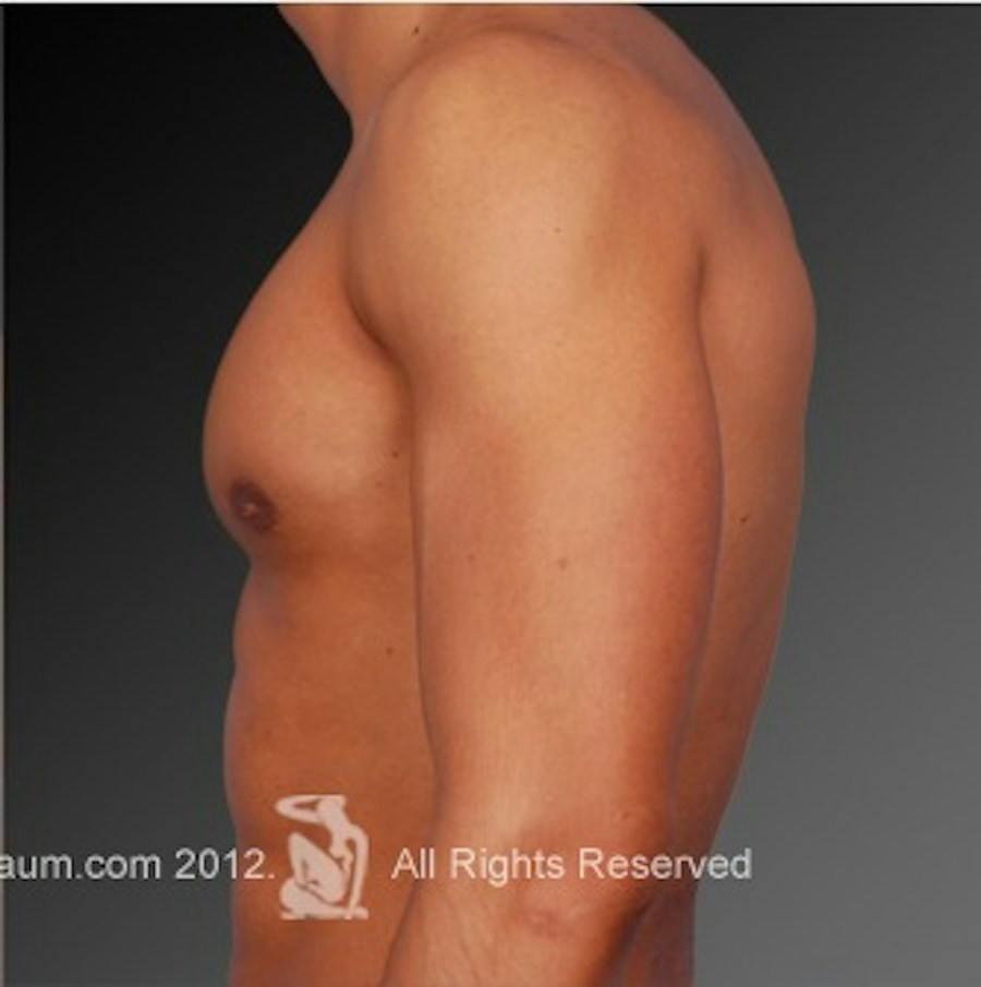 Patient 106041449 | Profile View | After | Chest (Gynecomastia) — Steven Teitelbaum MD -