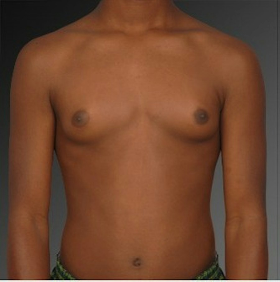 Patient 106041450 | Front View | Before | Chest (Gynecomastia) — Steven Teitelbaum MD -
