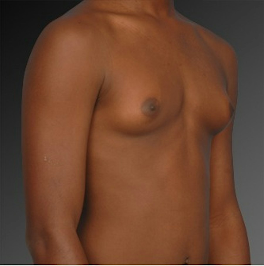 Patient 106041450 | Angle View | Before | Chest (Gynecomastia) — Steven Teitelbaum MD -