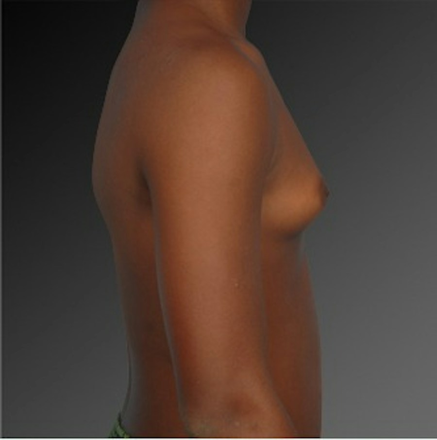 Patient 106041450 | Profile View | Before | Chest (Gynecomastia) — Steven Teitelbaum MD -