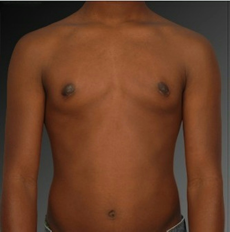 Patient 106041450 | Front View | After | Chest (Gynecomastia) — Steven Teitelbaum MD -