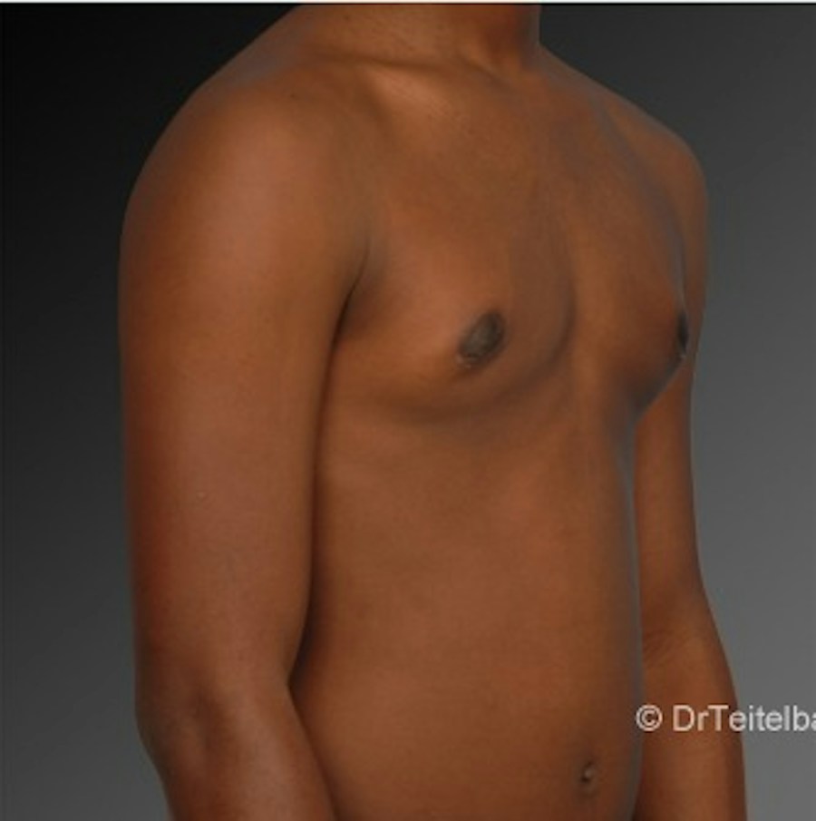 Patient 106041450 | Angle View | After | Chest (Gynecomastia) — Steven Teitelbaum MD -