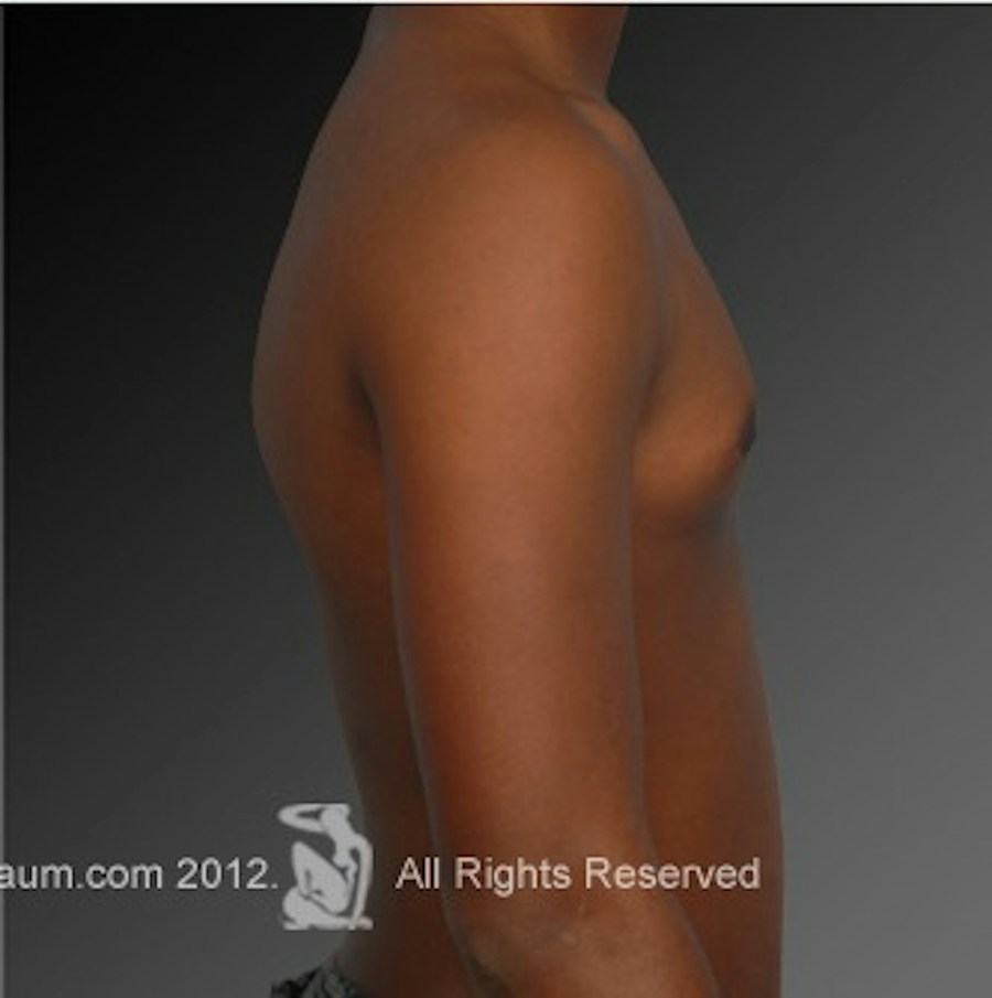 Patient 106041450 | Profile View | After | Chest (Gynecomastia) — Steven Teitelbaum MD -