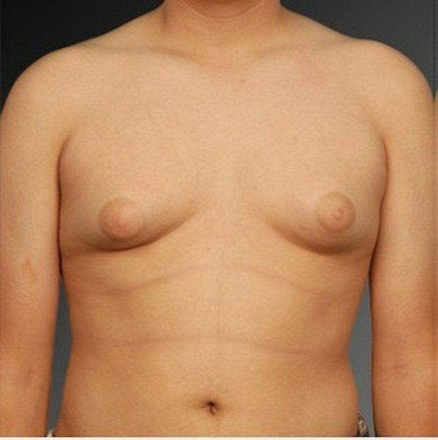 Patient 106041451 | Front View | Before | Chest (Gynecomastia) — Steven Teitelbaum MD -