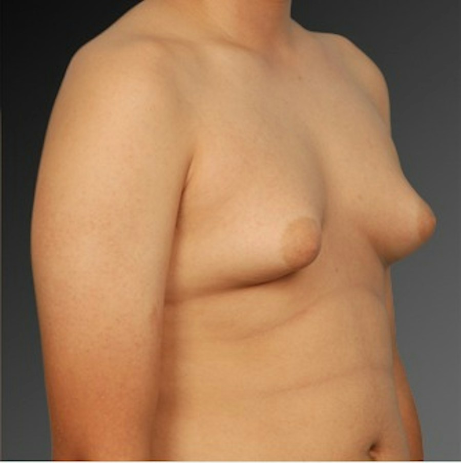 Patient 106041451 | Angle View | Before | Chest (Gynecomastia) — Steven Teitelbaum MD -