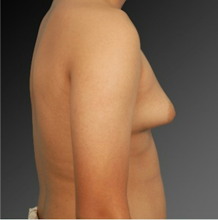 Patient 106041451 | Profile View | Before | Chest (Gynecomastia) — Steven Teitelbaum MD -