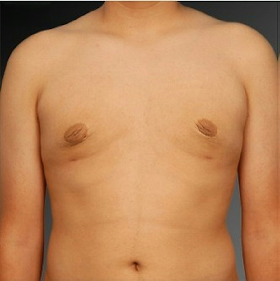 Patient 106041451 | Front View | After | Chest (Gynecomastia) — Steven Teitelbaum MD -