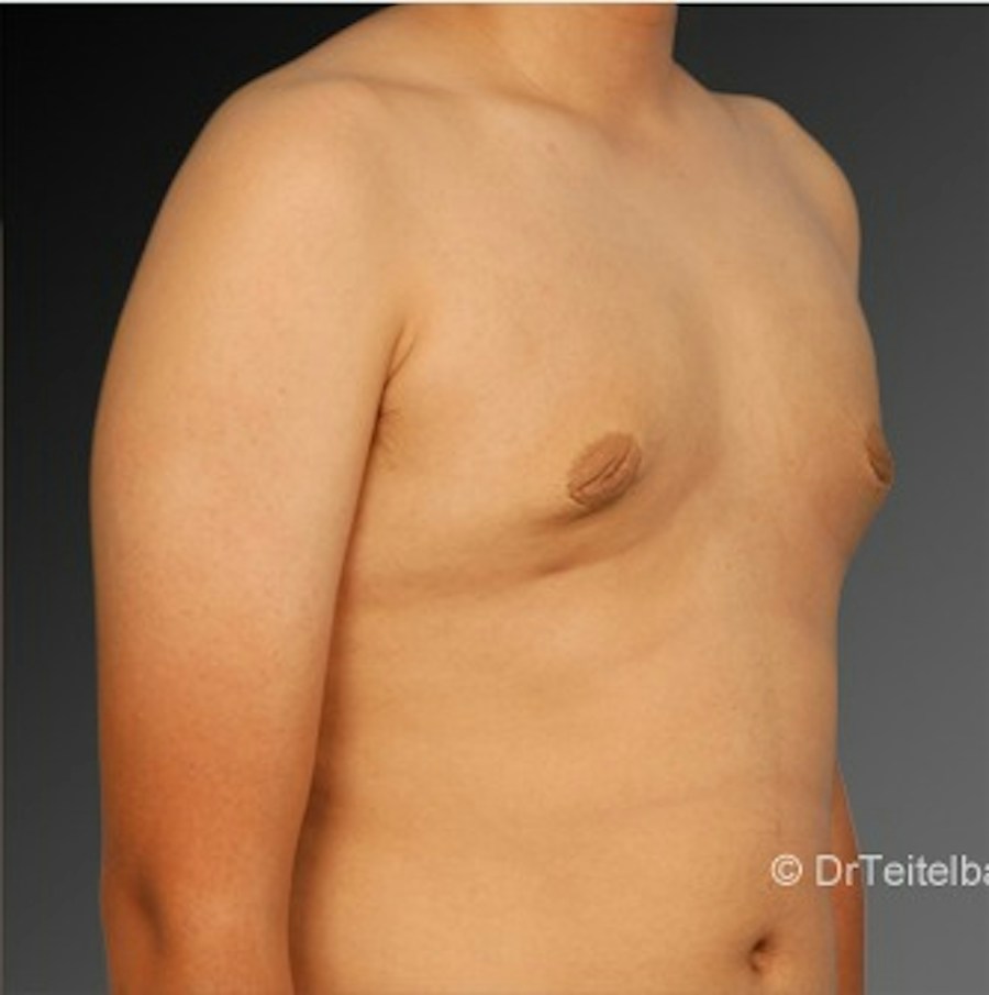 Patient 106041451 | Angle View | After | Chest (Gynecomastia) — Steven Teitelbaum MD -