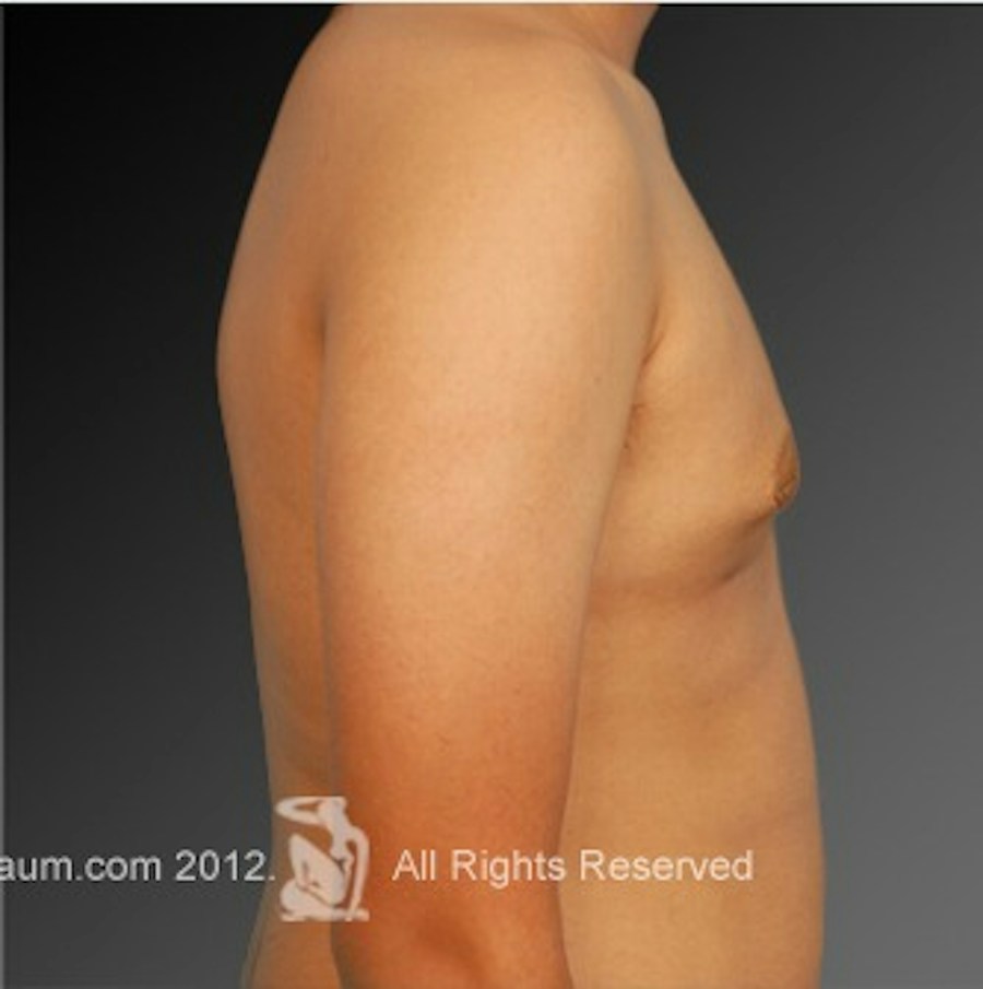 Patient 106041451 | Profile View | After | Chest (Gynecomastia) — Steven Teitelbaum MD -