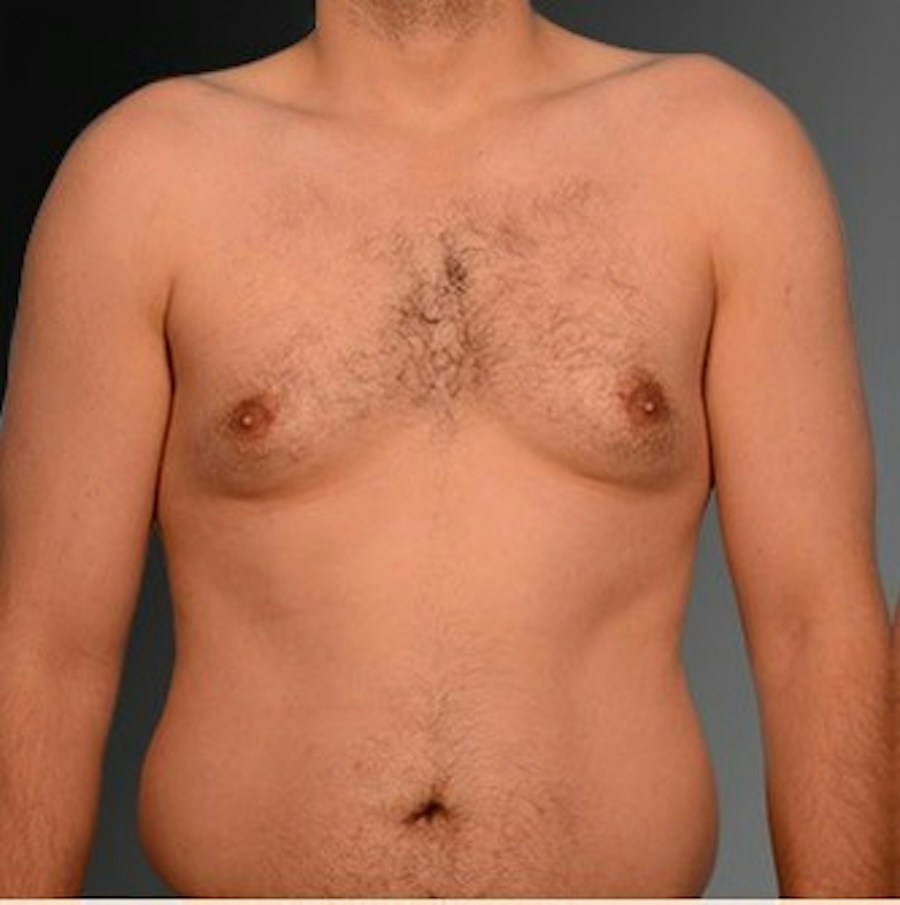 Patient 106041452 | Front View | Before | Chest (Gynecomastia) — Steven Teitelbaum MD -