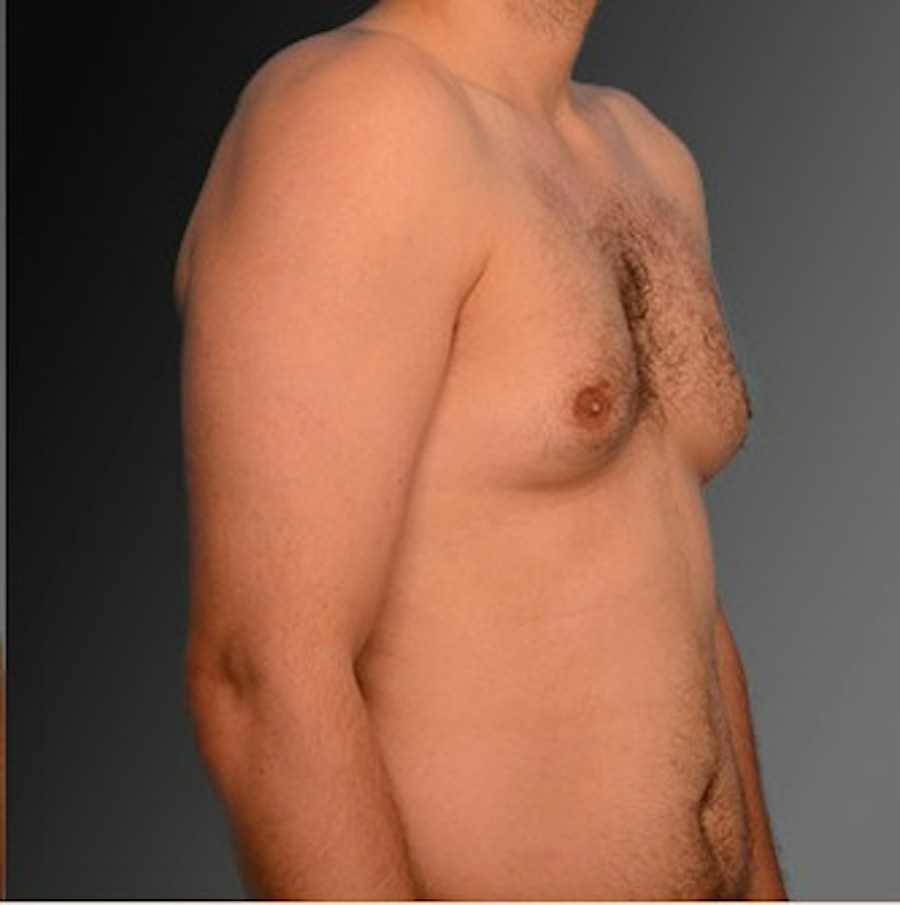 Patient 106041452 | Angle View | Before | Chest (Gynecomastia) — Steven Teitelbaum MD -
