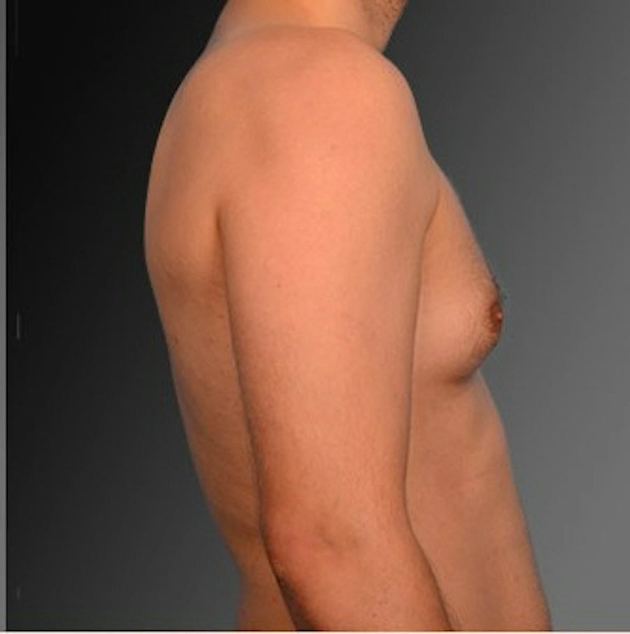 Patient 106041452 | Profile View | Before | Chest (Gynecomastia) — Steven Teitelbaum MD -
