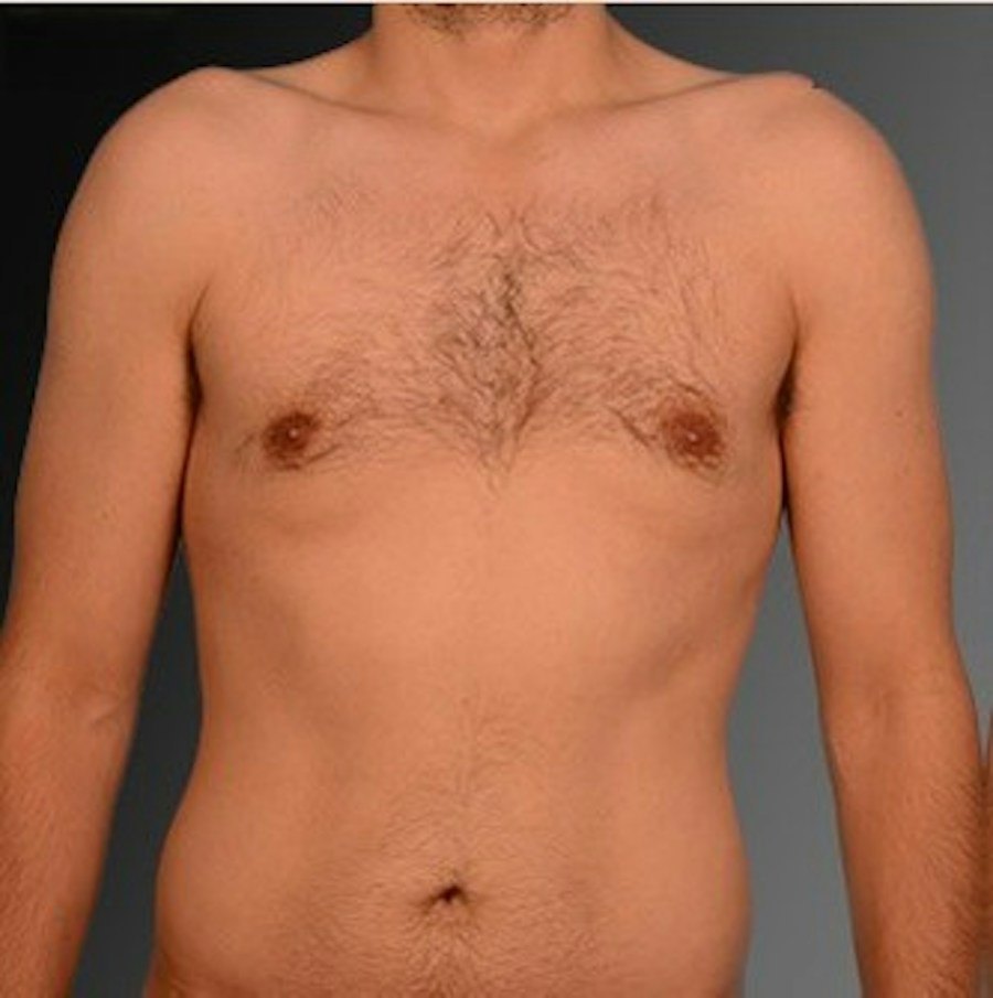 Patient 106041452 | Front View | After | Chest (Gynecomastia) — Steven Teitelbaum MD -