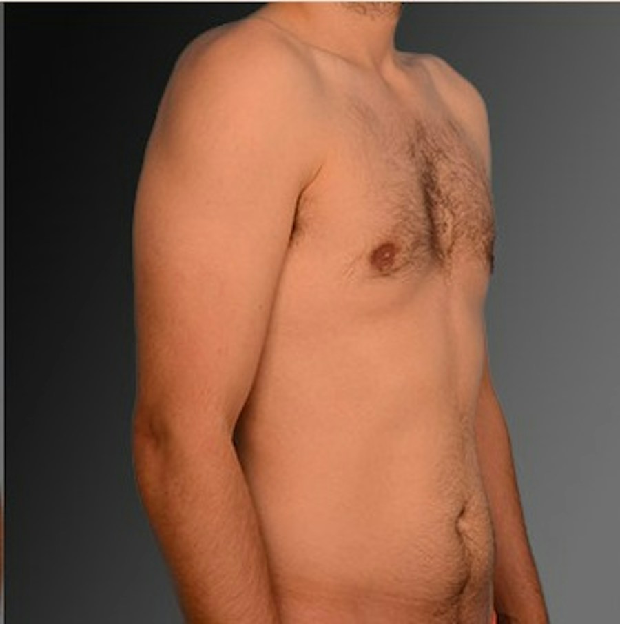 Patient 106041452 | Angle View | After | Chest (Gynecomastia) — Steven Teitelbaum MD -