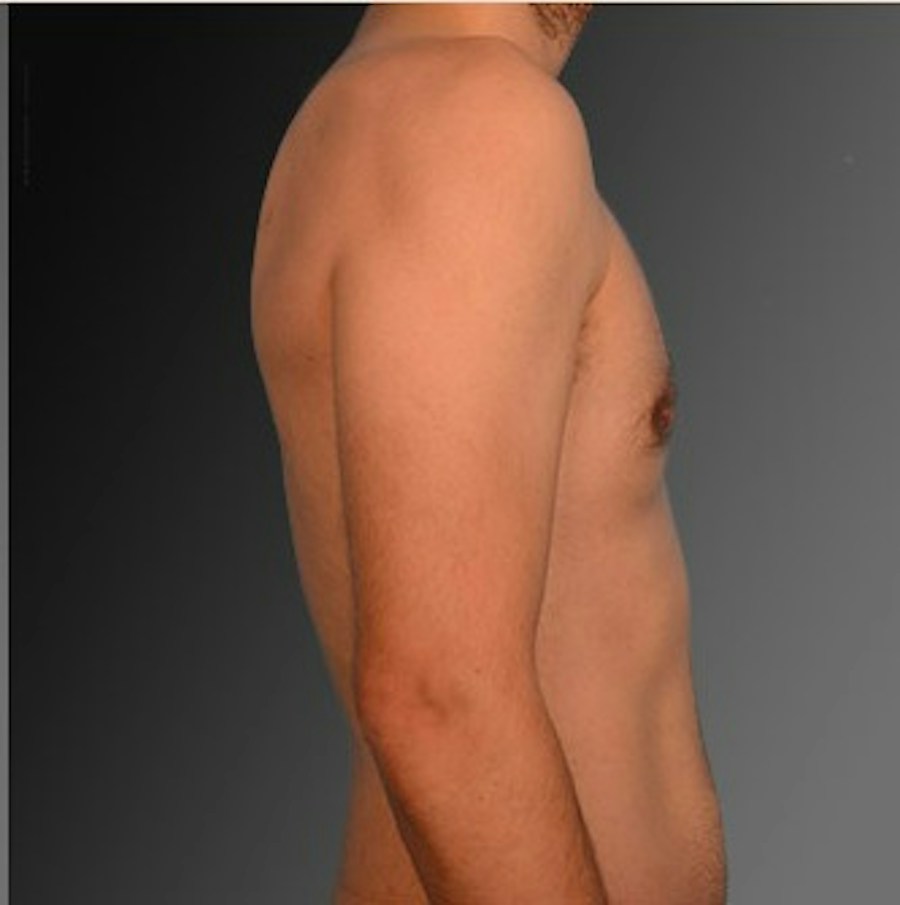 Patient 106041452 | Profile View | After | Chest (Gynecomastia) — Steven Teitelbaum MD -
