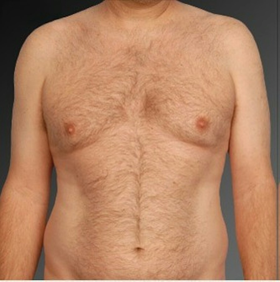 Patient 106041453 | Front View | Before | Chest (Gynecomastia) — Steven Teitelbaum MD -
