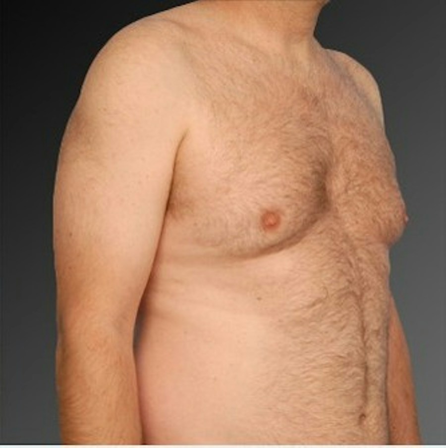 Patient 106041453 | Angle View | Before | Chest (Gynecomastia) — Steven Teitelbaum MD -