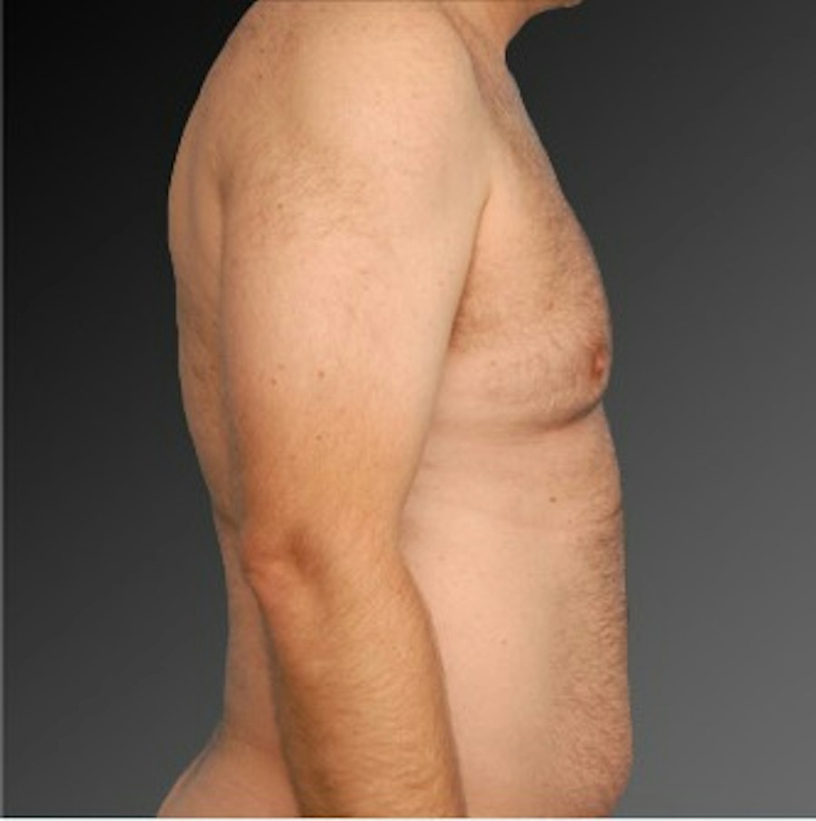 Patient 106041453 | Profile View | Before | Chest (Gynecomastia) — Steven Teitelbaum MD -