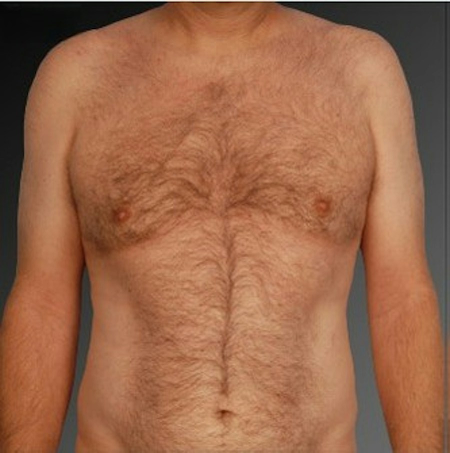 Patient 106041453 | Front View | After | Chest (Gynecomastia) — Steven Teitelbaum MD -