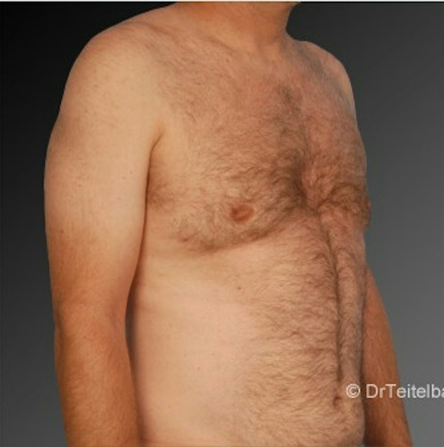 Patient 106041453 | Angle View | After | Chest (Gynecomastia) — Steven Teitelbaum MD -