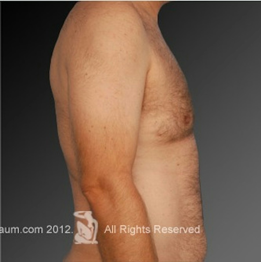 Patient 106041453 | Profile View | After | Chest (Gynecomastia) — Steven Teitelbaum MD -