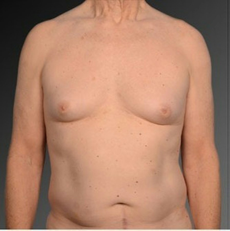 Patient 106041458 | Front View | Before | Chest (Gynecomastia) — Steven Teitelbaum MD -