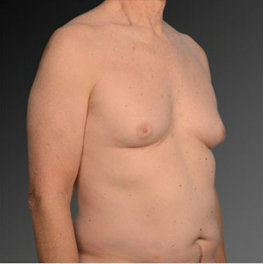Patient 106041458 | Angle View | Before | Chest (Gynecomastia) — Steven Teitelbaum MD -