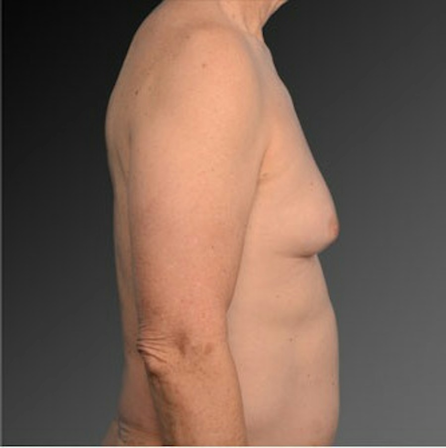 Patient 106041458 | Profile View | Before | Chest (Gynecomastia) — Steven Teitelbaum MD -