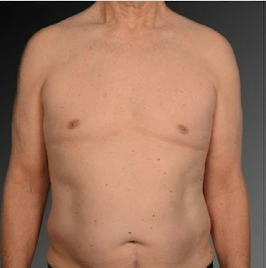 Patient 106041458 | Front View | After | Chest (Gynecomastia) — Steven Teitelbaum MD -