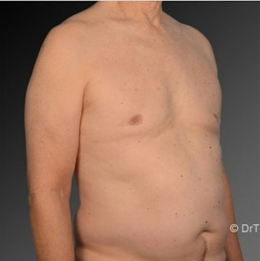Patient 106041458 | Angle View | After | Chest (Gynecomastia) — Steven Teitelbaum MD -