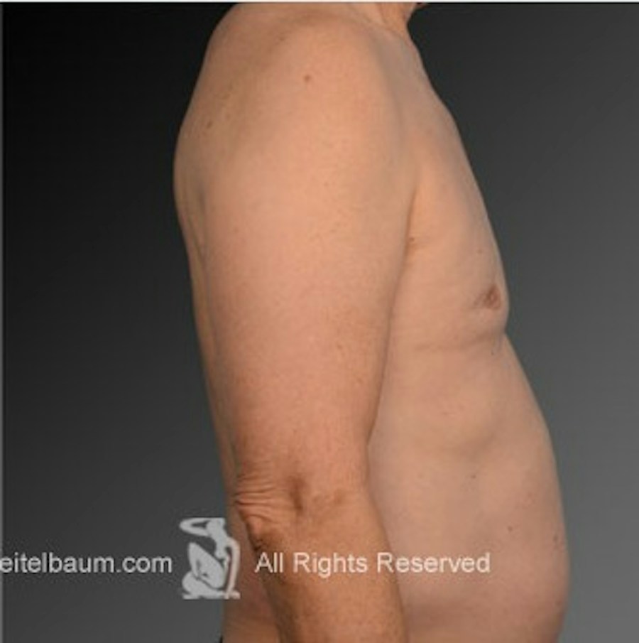Patient 106041458 | Profile View | After | Chest (Gynecomastia) — Steven Teitelbaum MD -