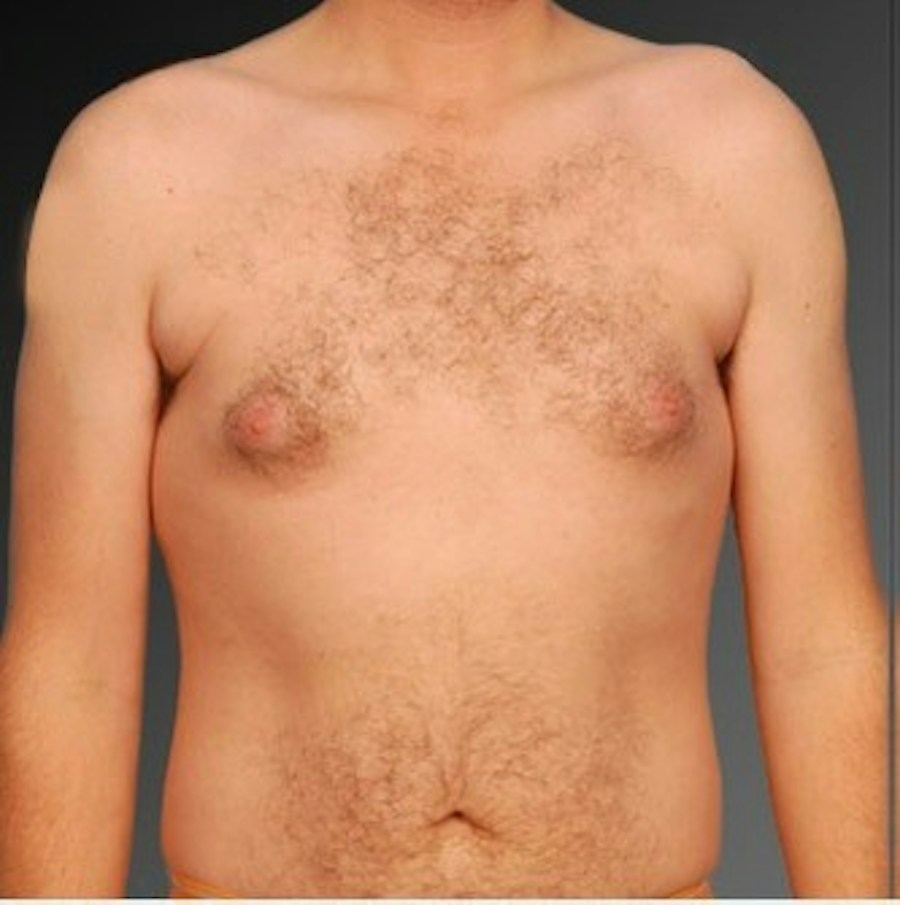 Patient 106041459 | Front View | Before | Chest (Gynecomastia) — Steven Teitelbaum MD -
