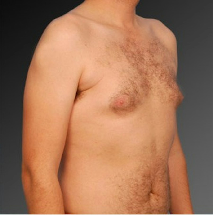 Patient 106041459 | Angle View | Before | Chest (Gynecomastia) — Steven Teitelbaum MD -